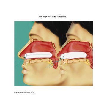 L&R Raucocel Straight Nasal Packing with Thread, 80mm (10 Pack)